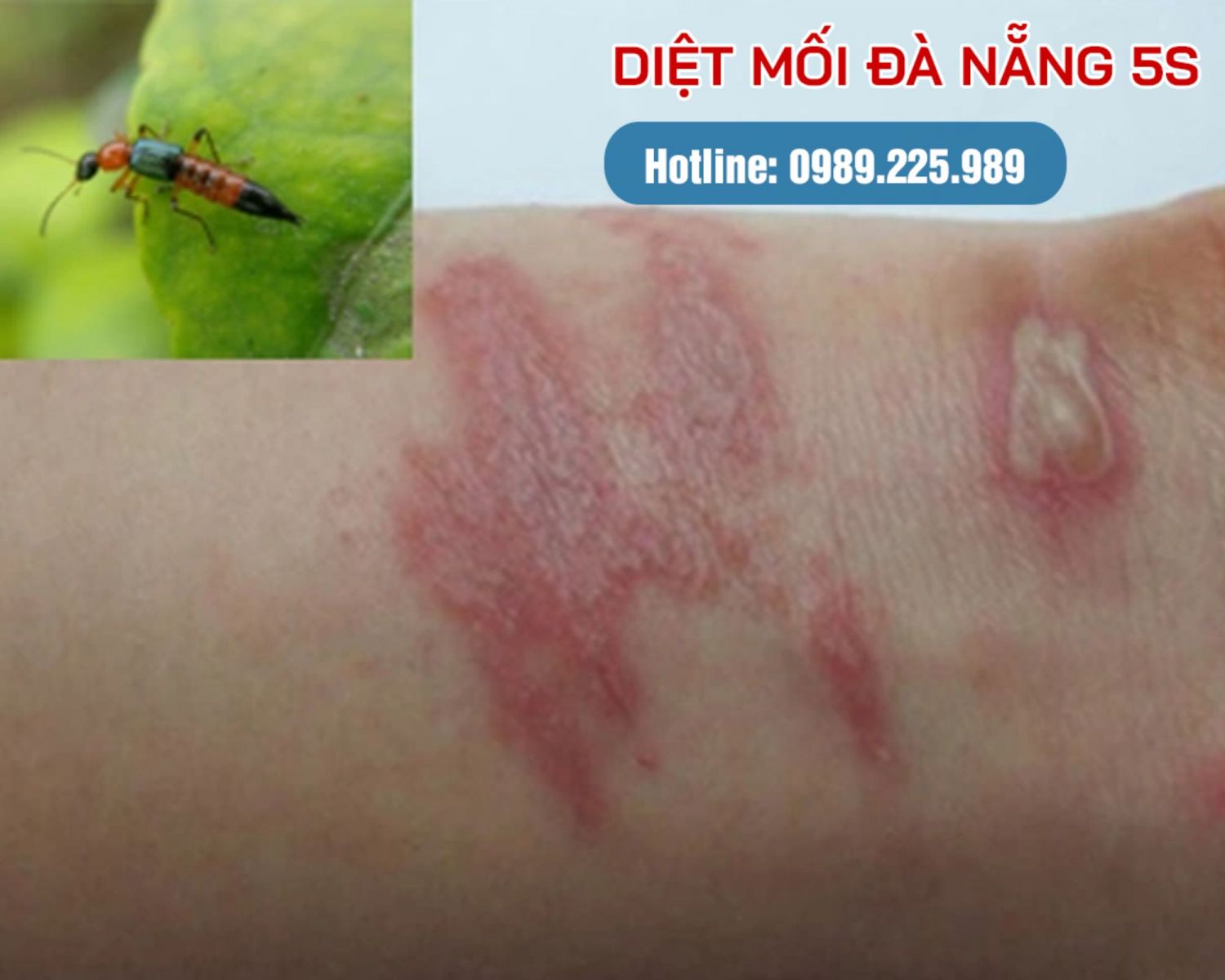 Cách tiêu diệt kiến ba khoang đuôi nhọn ra khỏi nhà hiệu quả 2 vết cắn kiến ba khoang
